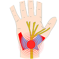손목터널증후군