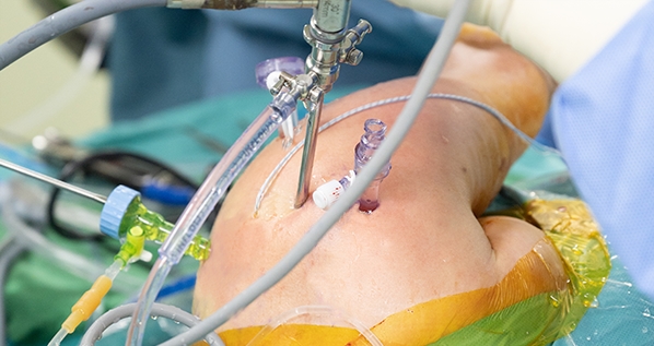 더본병원 관절경 관절막이완술 및 변연절제술 시술화면