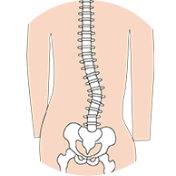 척추측만증