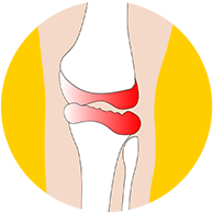 무릎연골판손상